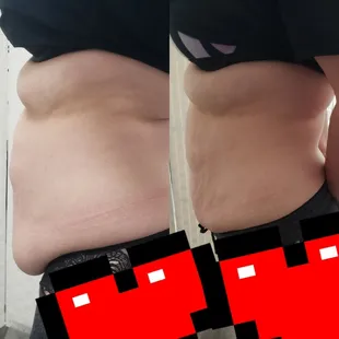 Cavitation/vaccum therapy/ Radio Frequency/laser lipo