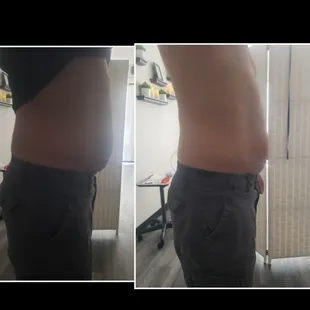 Cavitation/vaccum therapy/ Radio Frequency/laser lipo