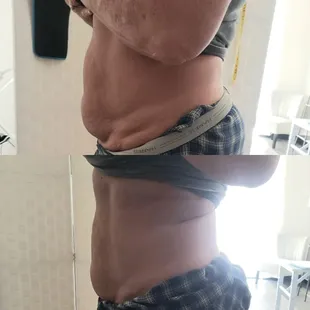 Cavitation/vaccum therapy/ Radio Frequency/laser lipo