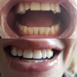 Teethwhitening/ Tooth Gems