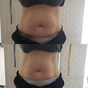 Cavitation/vaccum therapy/ Radio Frequency/laser lipo