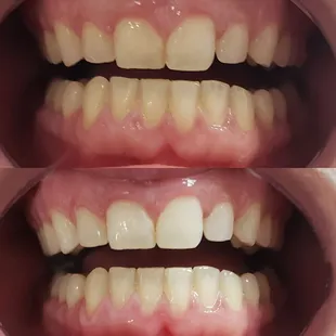 One hour Teeth Whitening