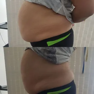 Cavitation/vaccum therapy/ Radio Frequency/laser lipo