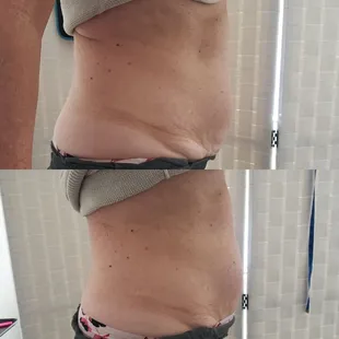 Cavitation/Radio Frequency