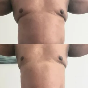 Cavitation/vaccum therapy/ Radio Frequency/laser lipo