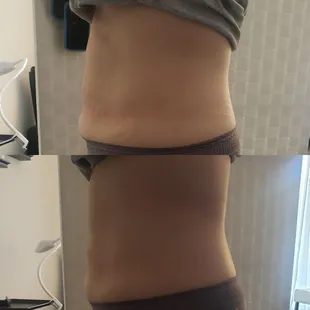Cavitation/vaccum therapy/ Radio Frequency/laser lipo