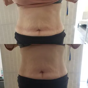 Cavitation/Radio Frequency