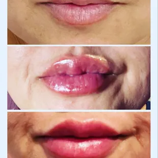 Hya Lip Infusion
