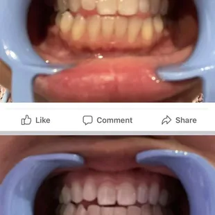 40 Minute teeth whitening session