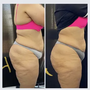 One volumizing butt lift