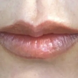After my lip fusion