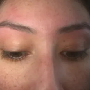 After thread. No thin and minimal redness/pain. Love them!