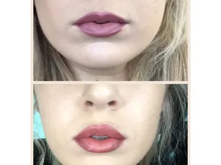 Cosmetic Injectables By Lisa