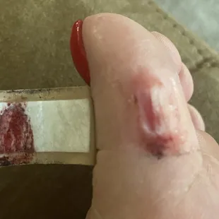 Pedicure Cut from a foot grader