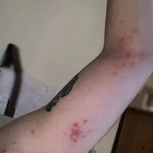 Picture of some of the bug bites I got during my stay.