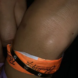 My fiancé's wrist with bruises.