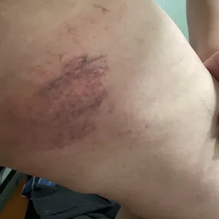 Bruise after wax.  The older lady repeatedly mentioned it would "go away" in 30 minutes.