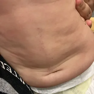 Bruise on daughters belly