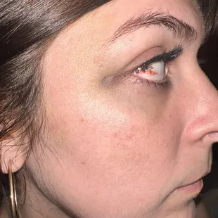 Scratched her eyeball and black eye