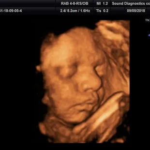 32 weeks "duck face"