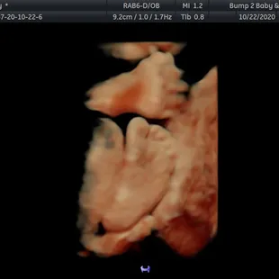 30 week hand and foot