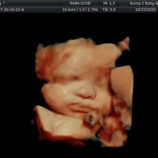 30 weeks with pinchable cheeks