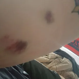 End results of IV removal the following day.