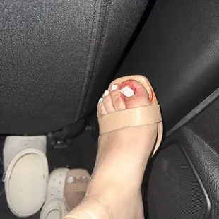 My lifted nail from when the security guards PUSHED ME DOWN THE STAIRS WITH FULL FORCE!!!
