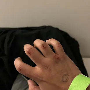 This is just my hand from when they shoved me down the stairs. I&apos;m surprised they haven&apos;t had a lawsuit yet