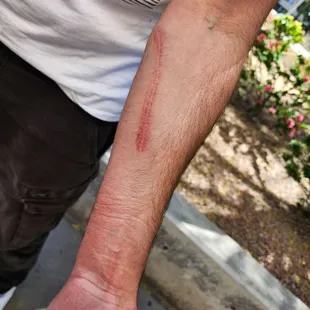 These were the marks from my boyfriend being tackled with knees in his back.