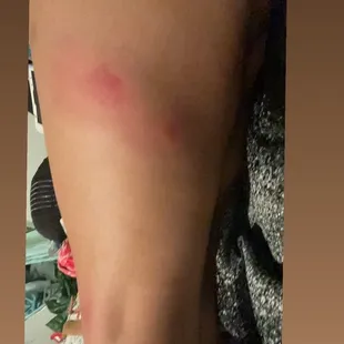 After going to the lake! Got attacked by damn mosquitoes