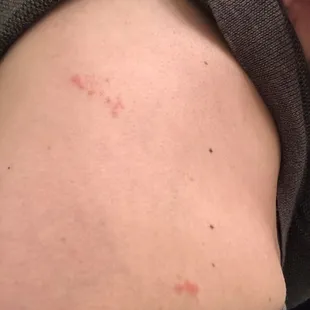 More bites all over