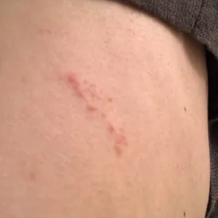 Bed bug bites