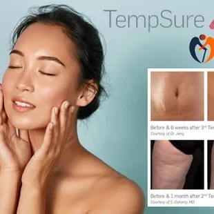 TempSure® Envi Skin Tightening for face and body
