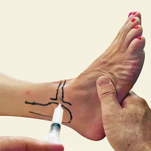 Joint injection for pain relief