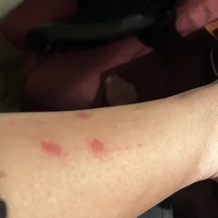 Painful red bumps on my leg!!
