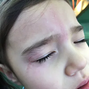 Rope burn from the climbing structure - they added a new cable at eye level on the bottom.