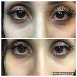 Under eye filler