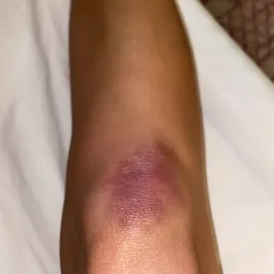 a person with a bruised leg