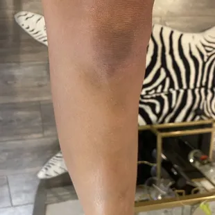 a woman's legs with variconized variconized variconized varicozed varicozed var