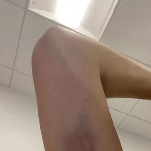 a man's arm with a wound on it