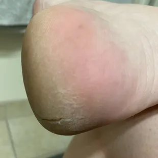 After pedicure my heel looks even worse