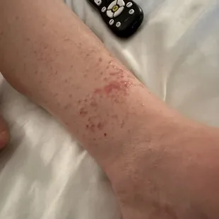 A picture of my wife's bug bites after day three here at the hotel.