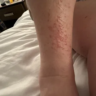 Here's a picture of my wife's right leg after the fleas attacked her in 208.