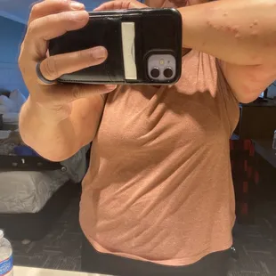 Left arm Bed bug bites