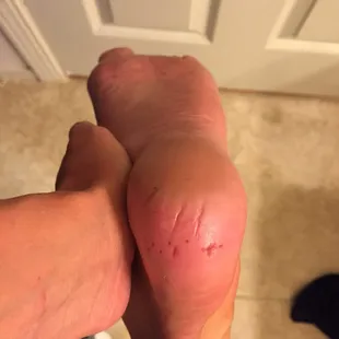 Terribly disappointed! My heel was scrubbed raw and left bleeding.
