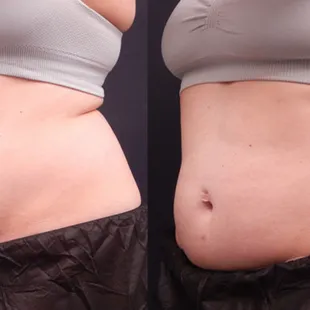 CoolSculpting