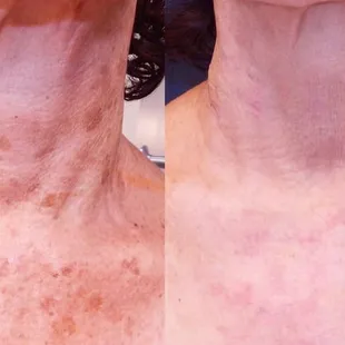 Halo Laser Treatment