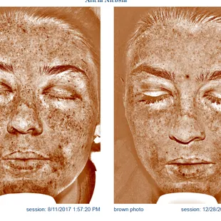 Halo Fractional laser for discoloration