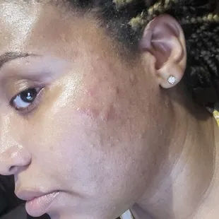 After laser hair removal